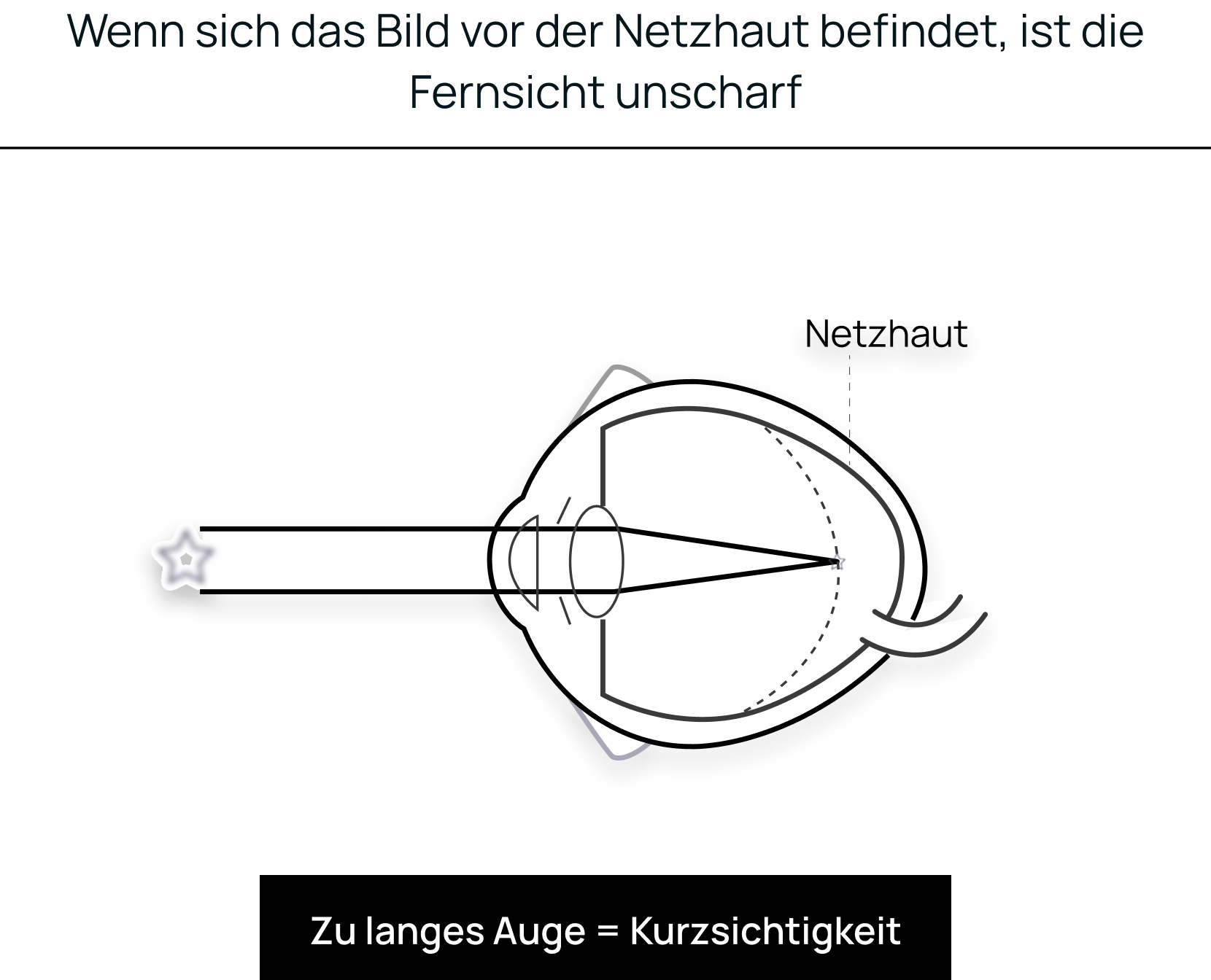 Optic2000 Engagements Myopie Schema 2 De
